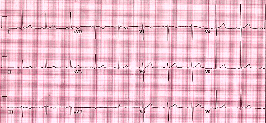 Left ventricular hypertrophy, diagnostic criteria: Most characteristic: increased QRS amplitude - R waves in left leads (I, avl, V5, V6) and S waves in the right leads (V1, V2) are oversized (and