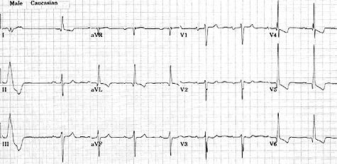 A 63 years old man has longstanding, uncontrolled hypertension. Is there evidence of heart disease from his hypertension?