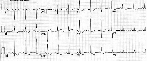 Right Ventricular Hypertrophy Right axis deviation, tall R waves