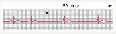Rare Sinoatrial Block The impulse from the sinus node is blocked before it enters the atrial muscle