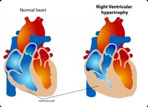 Right ventricular hypertrophy Tall R in avr,