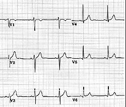 03 s in V1,2 Right QRS axis deviation T-wave