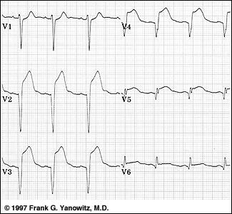 ST Elevation Elevation of the ST segment in at least 2 leads is consistent with a myocardial infarction Because blood