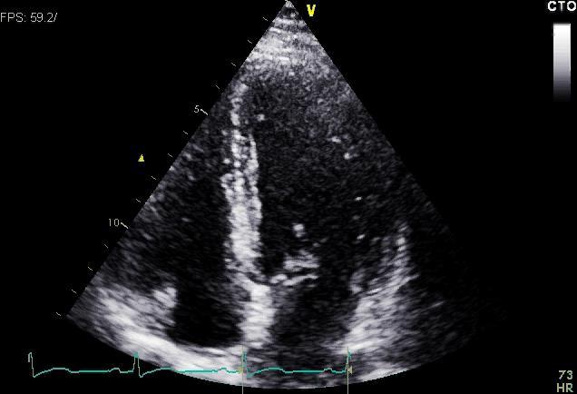 Case Example 51 year old woman, high risk
