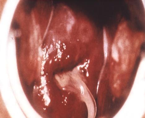 Chlamydia trachomatis Symptoms >50% no symptoms Signs Men Urethral discharge Dysuria Urethral itch or discomfort Rectal