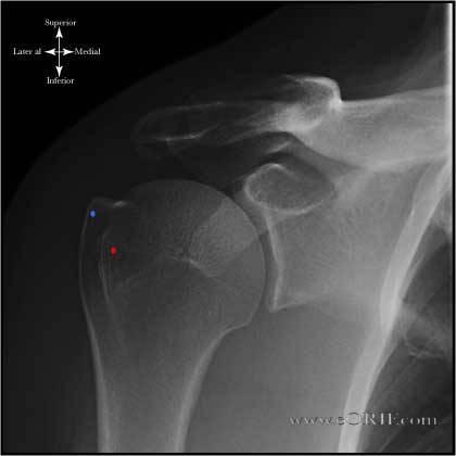 Posterior Glenohumeral Instability.