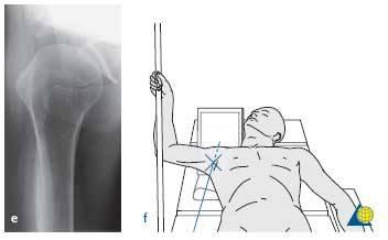 Axillary view Shoulder Xray Position: Patient seated at side of radiographic table with the arm abducted and axilla over the cassette.