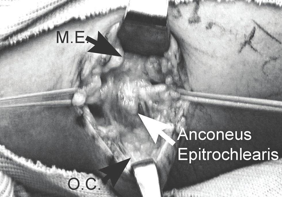 604 In-Ho J, et al. Cubital tunnel syndrome Fig 4. The anconeus epitroclearis muscle of the right elbow is demonstrated with medial epicondyle (M.E.) and olecranon (OC) marked with black arrows.