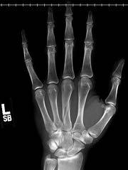 Phalanx & Metacarpal Fractures Most stable