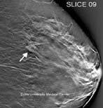 resolution and reasonable dose as mammography, while possibly
