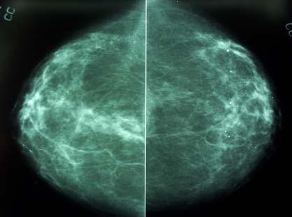 begin with mammogram, may need US <30