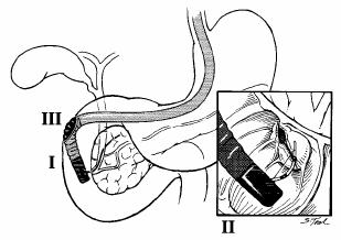 ERCP-related complications Perforations 1. Introducing/straightening of endoscope 2. ES-associated Mechanisms of perforation during performance of a ES Risk factors: 1. Billroth II anatomy 2.
