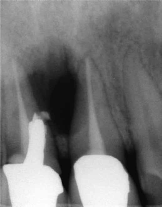 Zhang et al central incisor 3 years previously. The medical history of the patient was non-contributory.