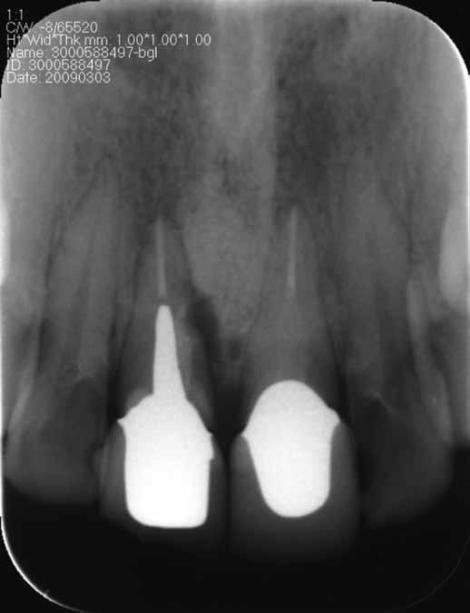 new post-crown restoration; and (c) apical radiolucency