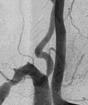 Vertebral Origin Disease Stenosis typically symptomatic if contralateral vertebral artery