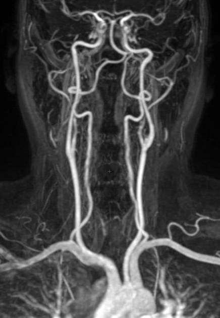 Overview Extracranial Carotid bifurcation Carotid endartectomy Carotid angioplasty and stenting Vertebral origin