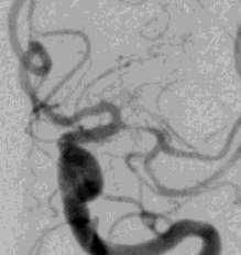 Angiographically verified 50-99% stenosis of major intracranial artery Warfarin with target