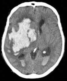 Stroke Etiology Hemorrhagic Hypertension Cerebral aneurysm
