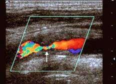 Carotid Stenosis- Evaluation Doppler Ultrasound Operator dependent CT angiography Radiation