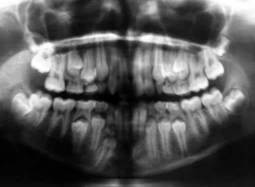 Morphologically, odontomes are of two typescompound or complex and can be found at any age with high prevalence in maxilla than in mandible.
