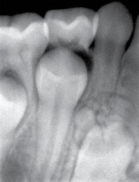 Interestingly, the radiograph also revealed multiple radiopaque masses around the crown of permanent mandibular right canine.