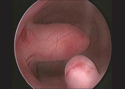 a. Endometrial polyps: Polyps are a common finding in endometrial curettings. Almost all are benign (99.9%) and they can cause AUB.
