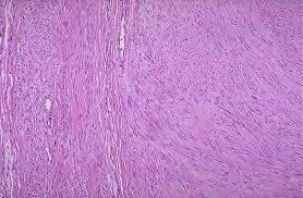 Microscopic features: Smooth muscle neoplasm There is no increased intra-leiomyomas hemorrhage or mitoses, No infiltration of the surrounding tissue I.e.<< no features of malignancy **Remember: Leiomyomas are benign tumors and they don't transform to malignancy (i.