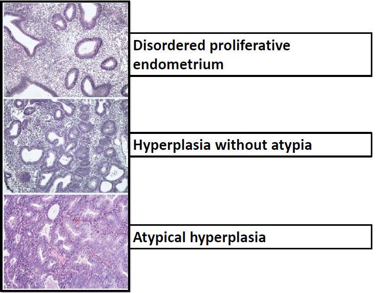 Hyperplasia with atypia Atypical cellular features present More complex glands Risk of carcinoma is 20-50%, and this why we need to catch it before the cancer occur Inactivation of PTEN tumor