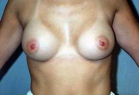 com (my main web site) to see pictures of some of my breast procedures.