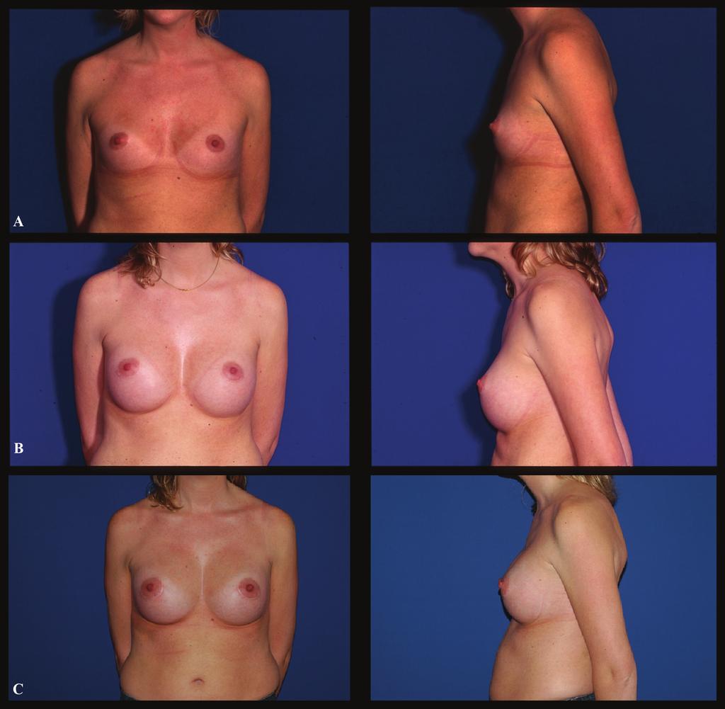 170 Capsular weakness around breast implant Fig. 1: Case 1 (Frontal and profile view): A. Preoperative aspect of a 25 year-old female who presented hypotrophyc breasts. B.