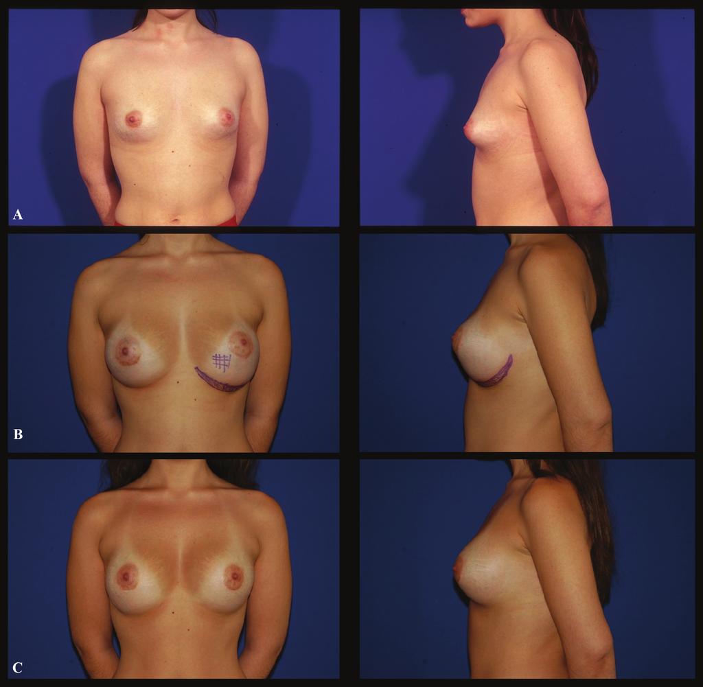 Arquero et al. 171 Fig. 2: Case 2 (Frontal and profile view): A. Preoperative aspect of a 19 year-old white female who presented a left tuberous breast. B.