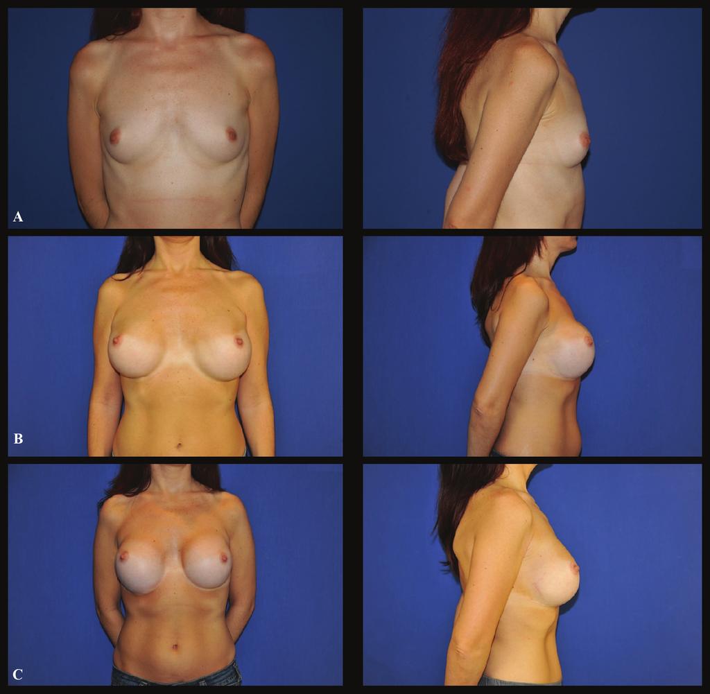 172 Capsular weakness around breast implant Fig. 3: Case 3 (Frontal and profile view): A. Preoperative aspect of a 31 year-old white female who presented hypotrophyc breasts. B.
