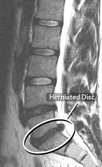 Approximately 90% of disc herniations will occur at L4-L5 or L5-S1, which causes pain in the L5 nerve or S1 nerve.