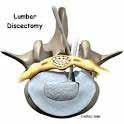 Lumbar Discectomy A Discectomy is removing the soft gel-like material that has extruded out of the disc into the neural canal.