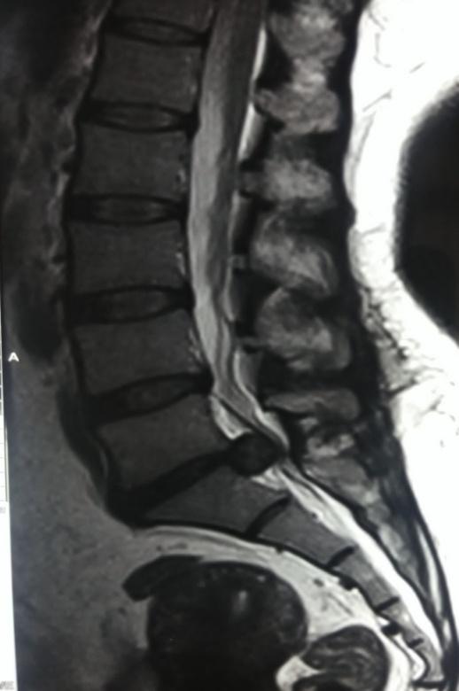 400 Prasad et al - Spontaneous regression of extruded lumbar disc herniation lumbosacral spine revealed a left posterolateral disc extrusion at L5-S1
