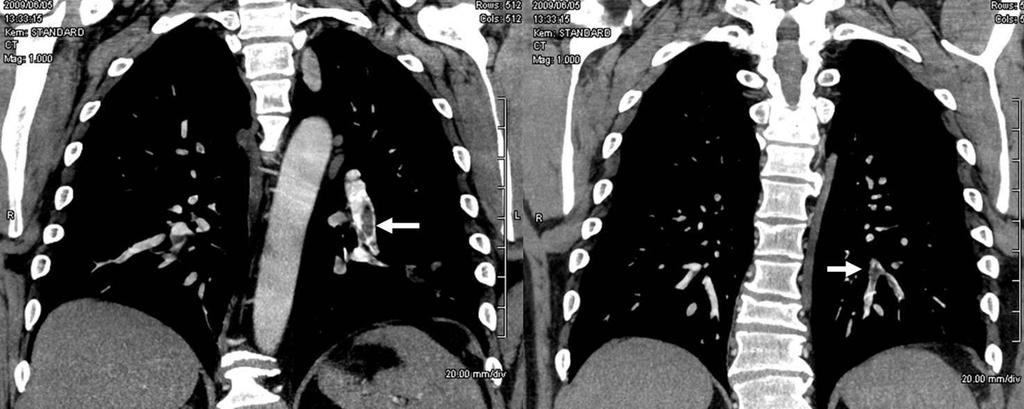 PULMONARY EMBOLISM: multiple pulmonary emboli or thrombi These two coronal CT images are of the same patient who presented with dyspnea, chest pain, and mild core pulmonale.