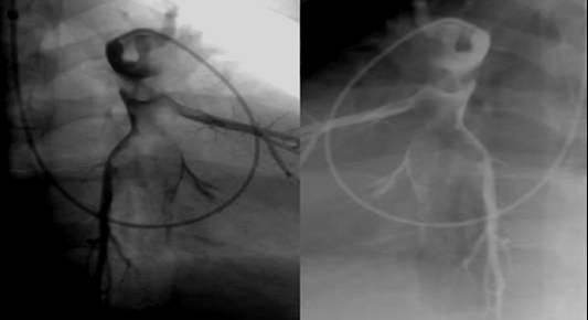 PULMONARY EMBOLISM: pulmonary angiography This angiograph is a localization image that shows