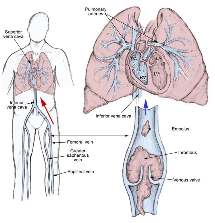 Pulmonary embolism (PE) is a blockage of the main artery of the lung or one of its branches by a substance that has travelled from elsewhere in the body through the bloodstream (embolism).