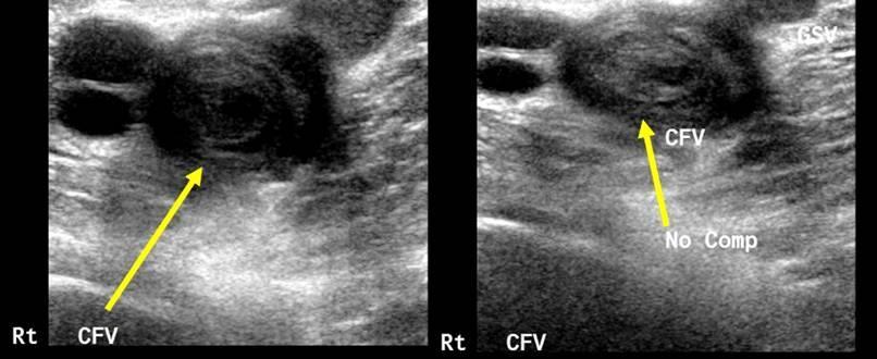 PULMONARY EMBOLISM: compression venous ultrasonography ession two crossection