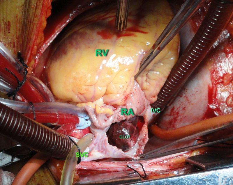 Following rapid transfer to the operating room and induction of anaesthesia and median sternotomy, normothermic cardiopulmonary bypass should be instituted.