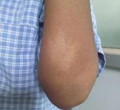 One child of LL leprosy (BI-5+)with HIV positive, presented