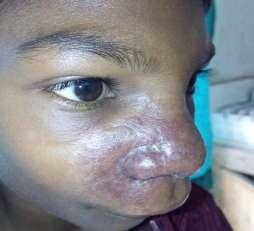 Other child of BL leprosy with bacillary index 4+ presented