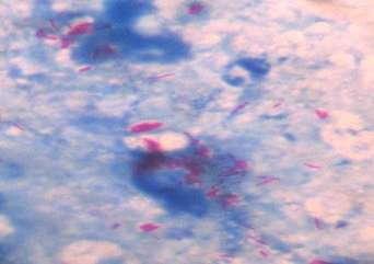 10 Tuberculoid leprosy section(h&e stain X100) Fig: 11