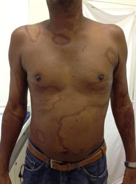 Borderline Borderline/Mid- Clinical: Multiple asymmetric plaques with possible decreased sensation/sweating.
