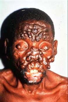 Lepromatous Leprosy Clinical: Leonine facies, madarosis, saddle nose, etc. Bacteriolgical: 3+ to 6+.