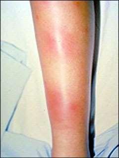 Type 2 Reaction/Erythema Nodosum Leprosy Erythema Nodusum-like lesions that occur in either BL or LL. Due to circulating immune complexes.