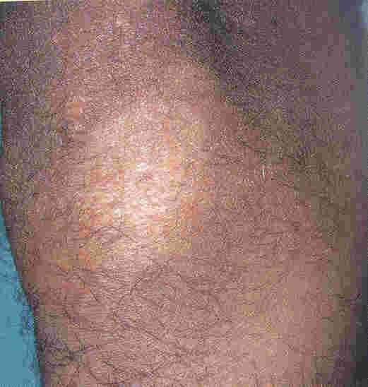 Indeterminate Leprosy Early stage of