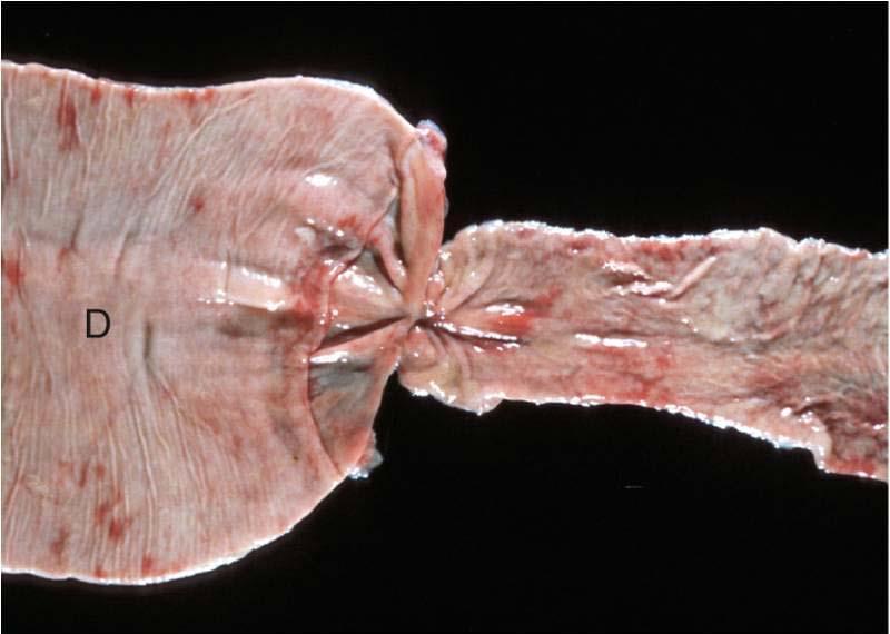 (absence of peristalsis) Enterolith, horse Foreign body (sock), accordion-folded