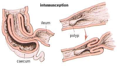 Intussusception - components intussuscepiens intussusceptum traction (leading)