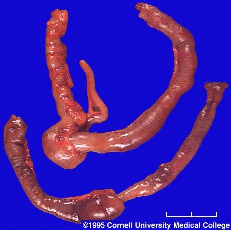Intussusception - sequalae intestinal obstruction